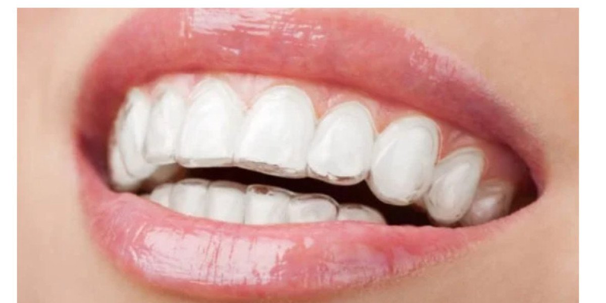 Straighten Your Smile with Teeth Aligners: Why Choose Invisible Aligners at Dental Opal?