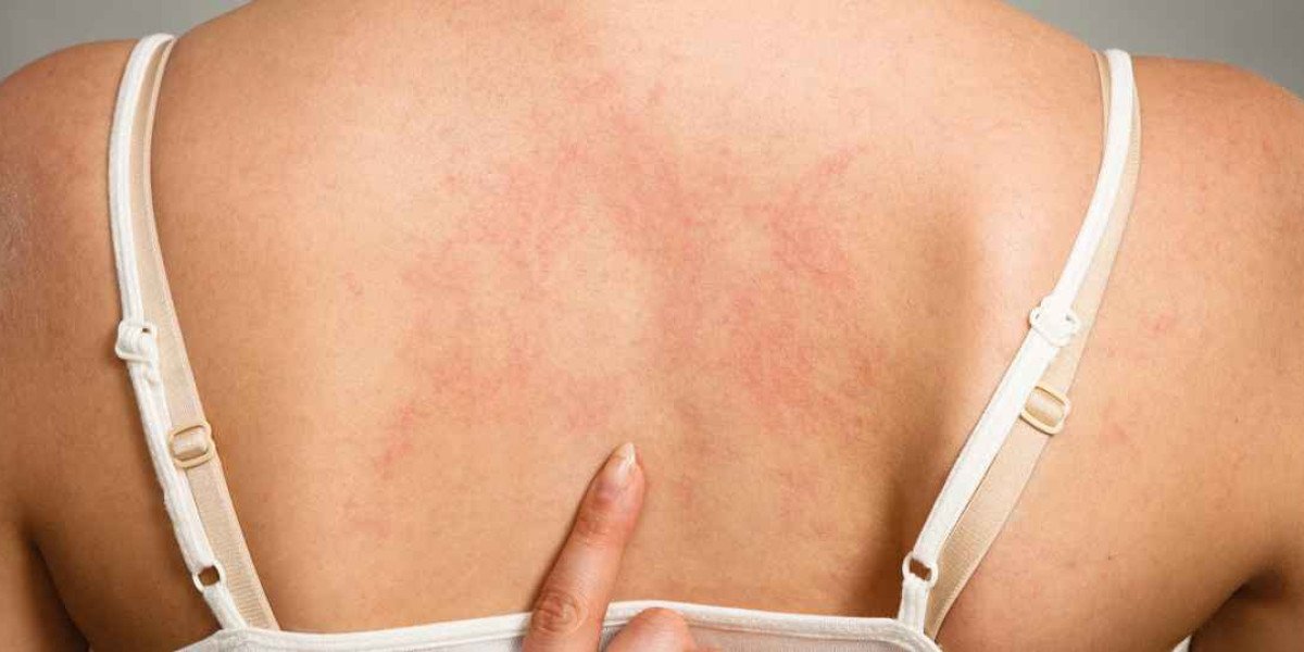 What Causes Eczema on Back? Triggers and Prevention Tips